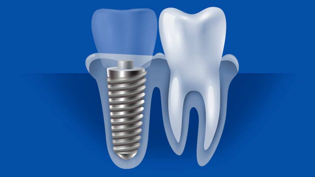 zirconia implants
