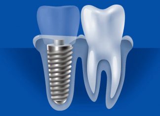 Benefits of Zirconia Implants