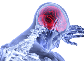 Brain Astrocytoma