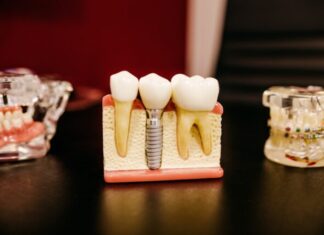 How Are Dental Implants an Affordable Investment in the Long Run? white and yellow wooden condiment shakers