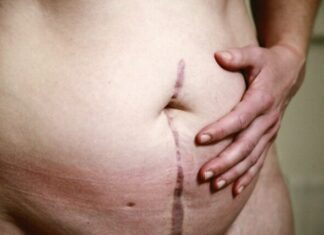 Understanding the Downsides of a Mommy Makeover topless woman with skin condition