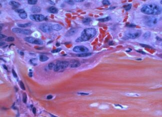 What Are the Early Signs of Mesothelioma? blue and white abstract painting