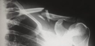 human X-ray result chart