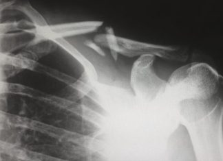 What Evidence a Personal Injury Lawyer Needs to Win Your Case human X-ray result chart