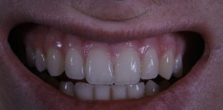a close up of a person's mouth with a missing tooth