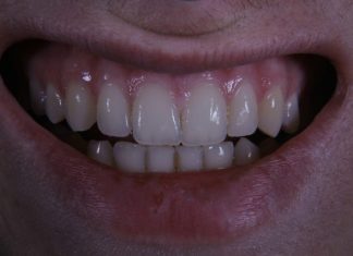Essential Tools for Safe Fluoride Application a close up of a person's mouth with a missing tooth