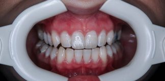 a person's mouth with teeth