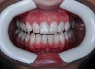 a person's mouth with teeth
