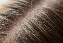 Does Thyroid Cause Hair Loss?