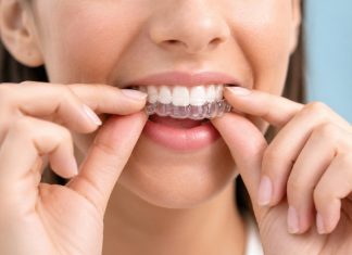 Woman adjusting clear dental aligners on teeth