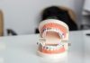 Choosing Metal Braces: What Parents and Adults Should Actually Expect white and brown ceramic cake figurine