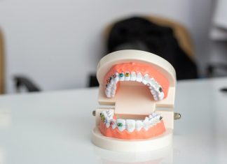 Choosing Metal Braces: What Parents and Adults Should Actually Expect white and brown ceramic cake figurine